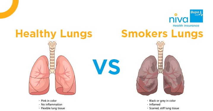 흡연자와 비흡연자의 폐 차이